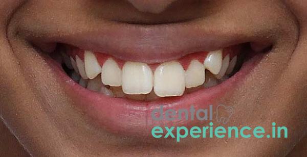 Wide Tooth